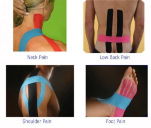 What is Kinesio Taping?